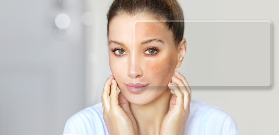 Dark spots, freckles,hyperpigmentation(melasma or chloasma),concept- skin lightening, skin whitening, Skin Brightening